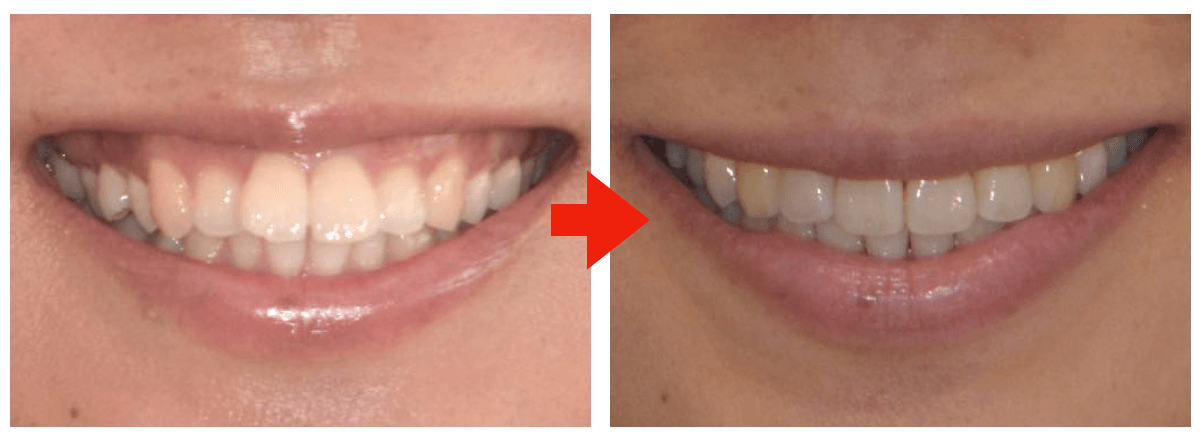 MOOフィロソフィーによる非抜歯矯正治療 - イースマイル国際矯正歯科 