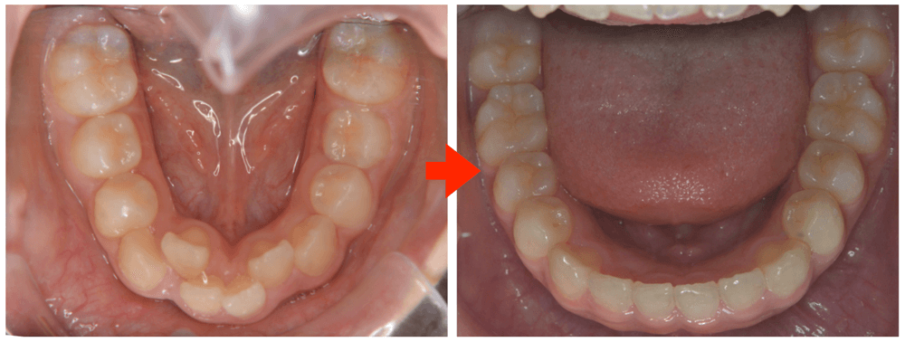 MOOフィロソフィーによる非抜歯矯正治療 - イースマイル国際矯正歯科 