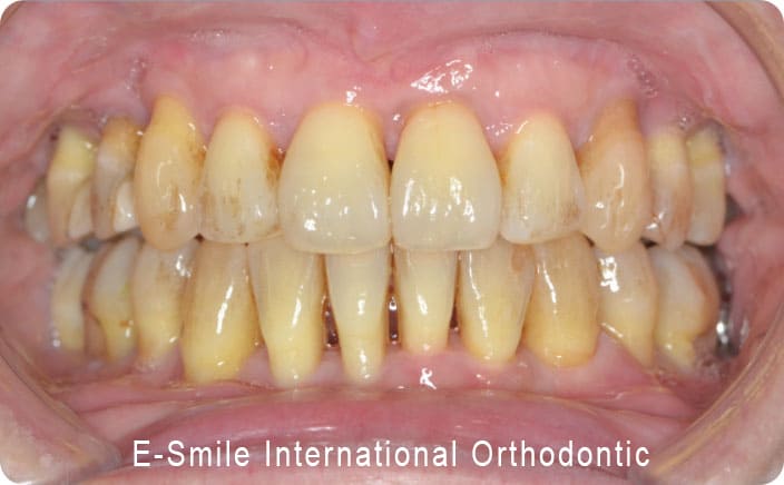 矯正治療後